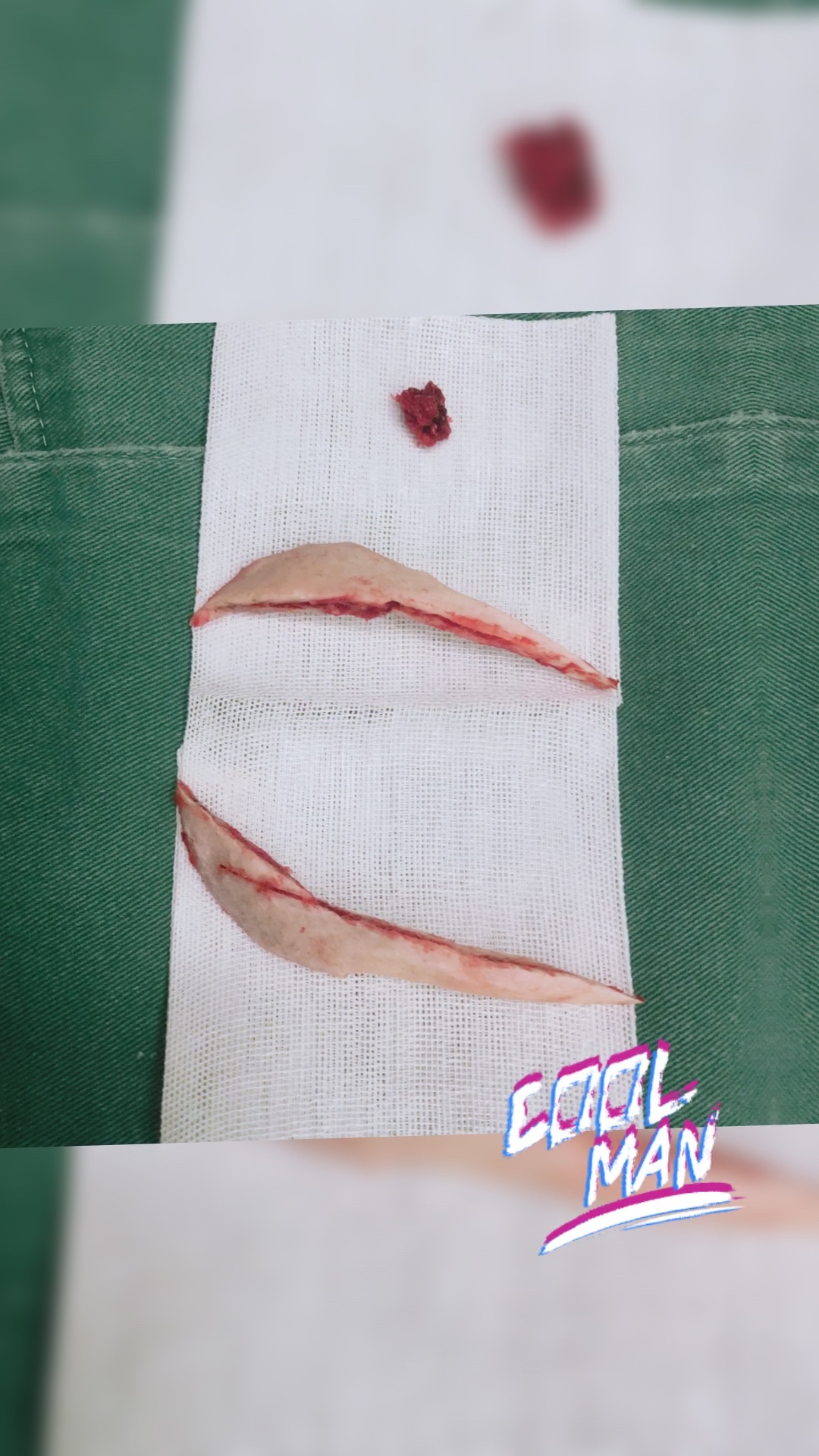 下颌角长曲线截骨磨骨整形