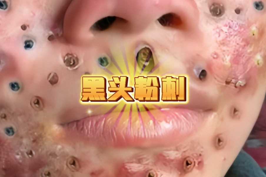 这鼻子还有救吗?被黑头粉刺痘痘包围