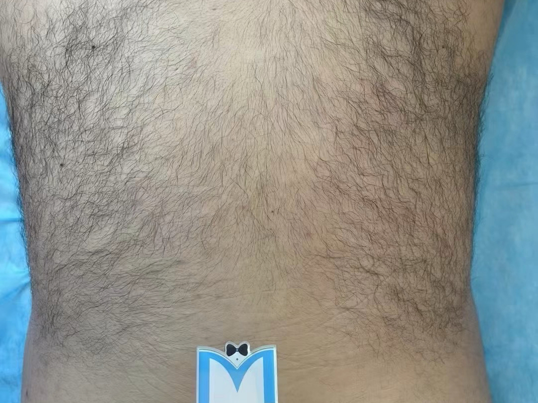 【上海铭轩男士私密脱毛】视频已打包,欢迎围观!