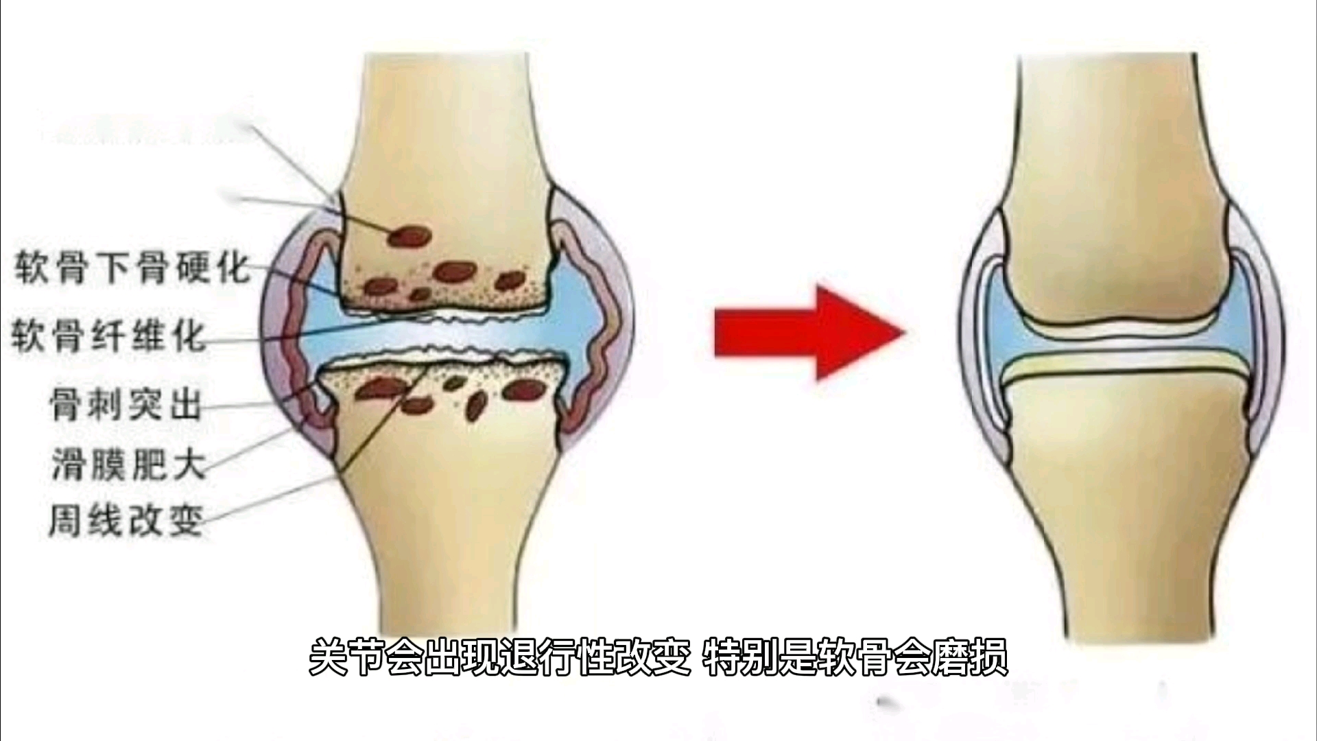 氨糖真是膝盖的救星?哔哩哔哩bilibili