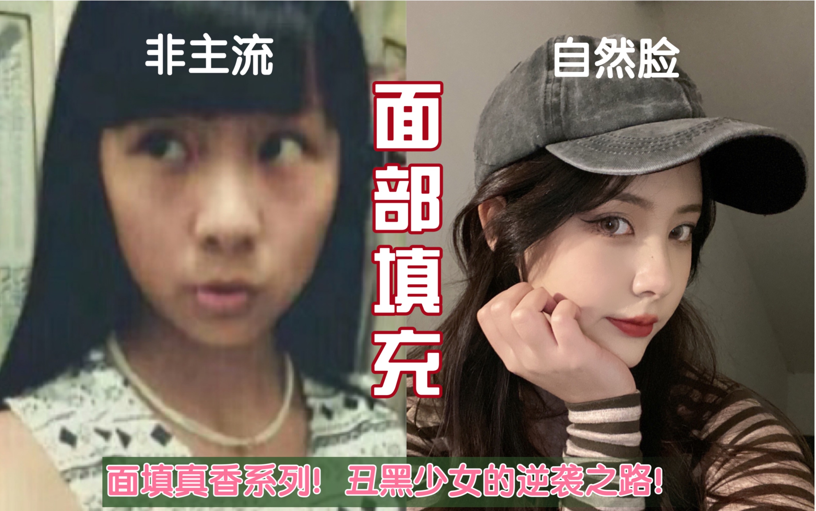 [图]真香！十八岁时做的面部填充让我从非主流蜕变，如今5年怎样了？来聊一聊面填的经验之谈！