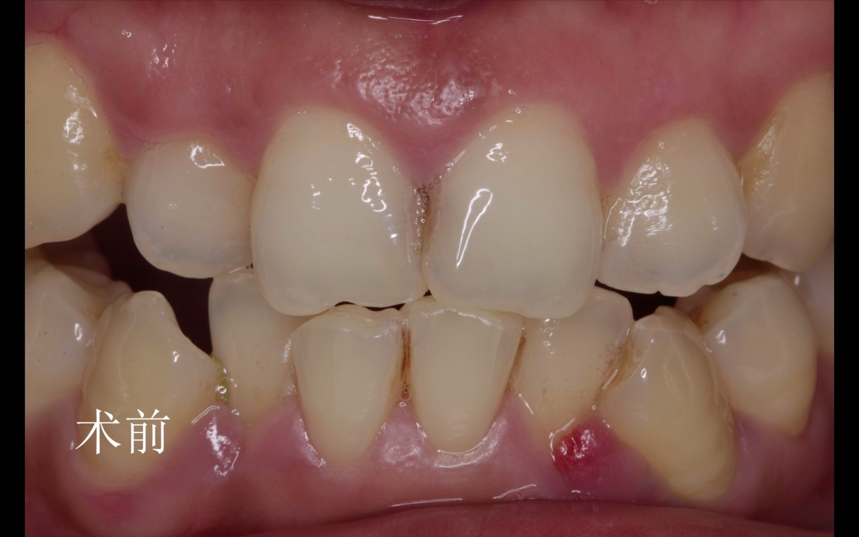 前牙三类洞树脂充填(补牙)