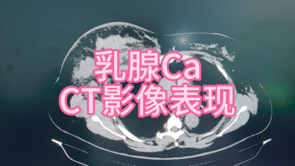 乳腺Ca的CT影像表现!哔哩哔哩bilibili