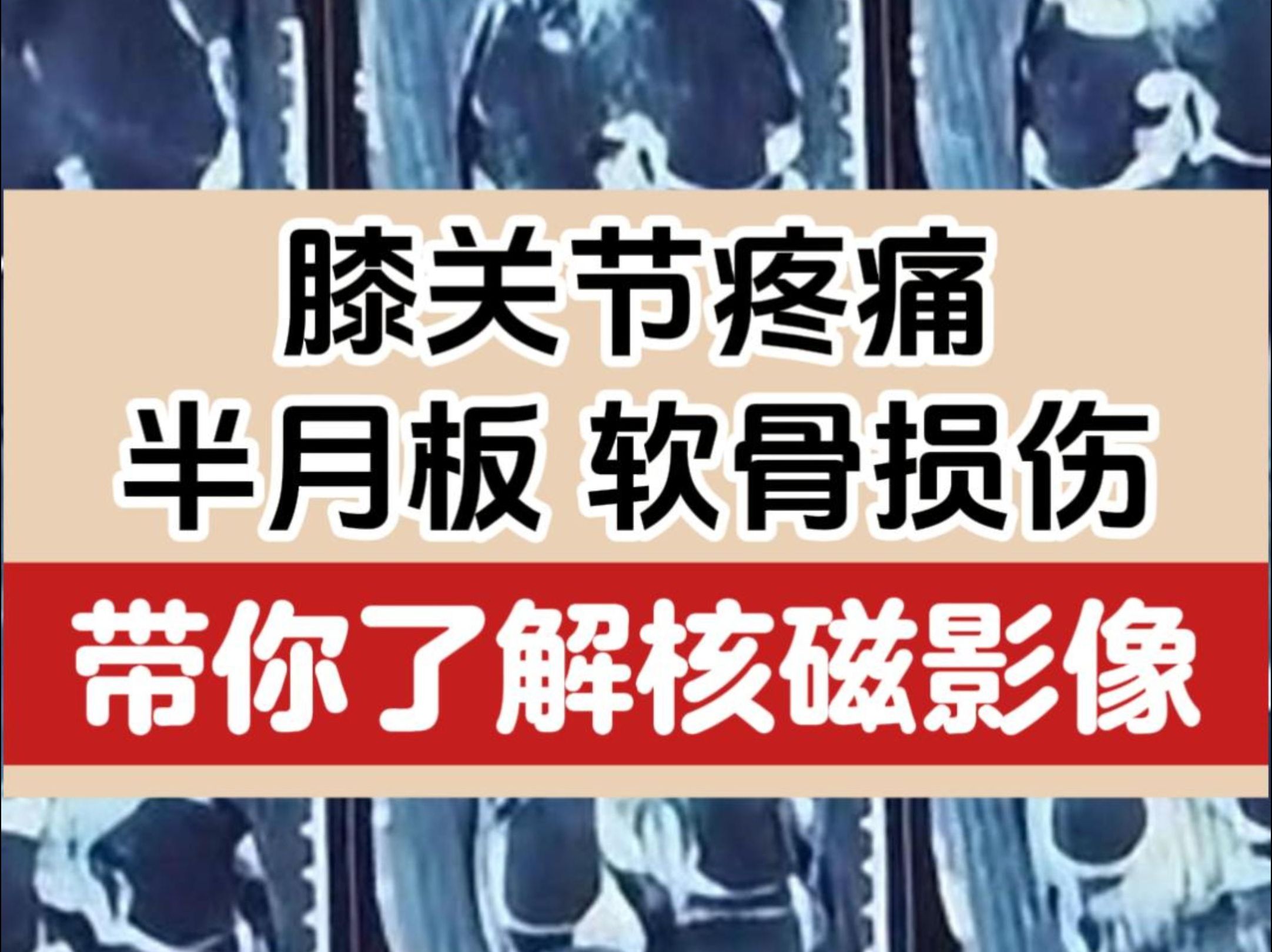 膝盖疼痛,半月板软骨损伤,带你了解这些在核磁上的表现哔哩哔哩bilibili