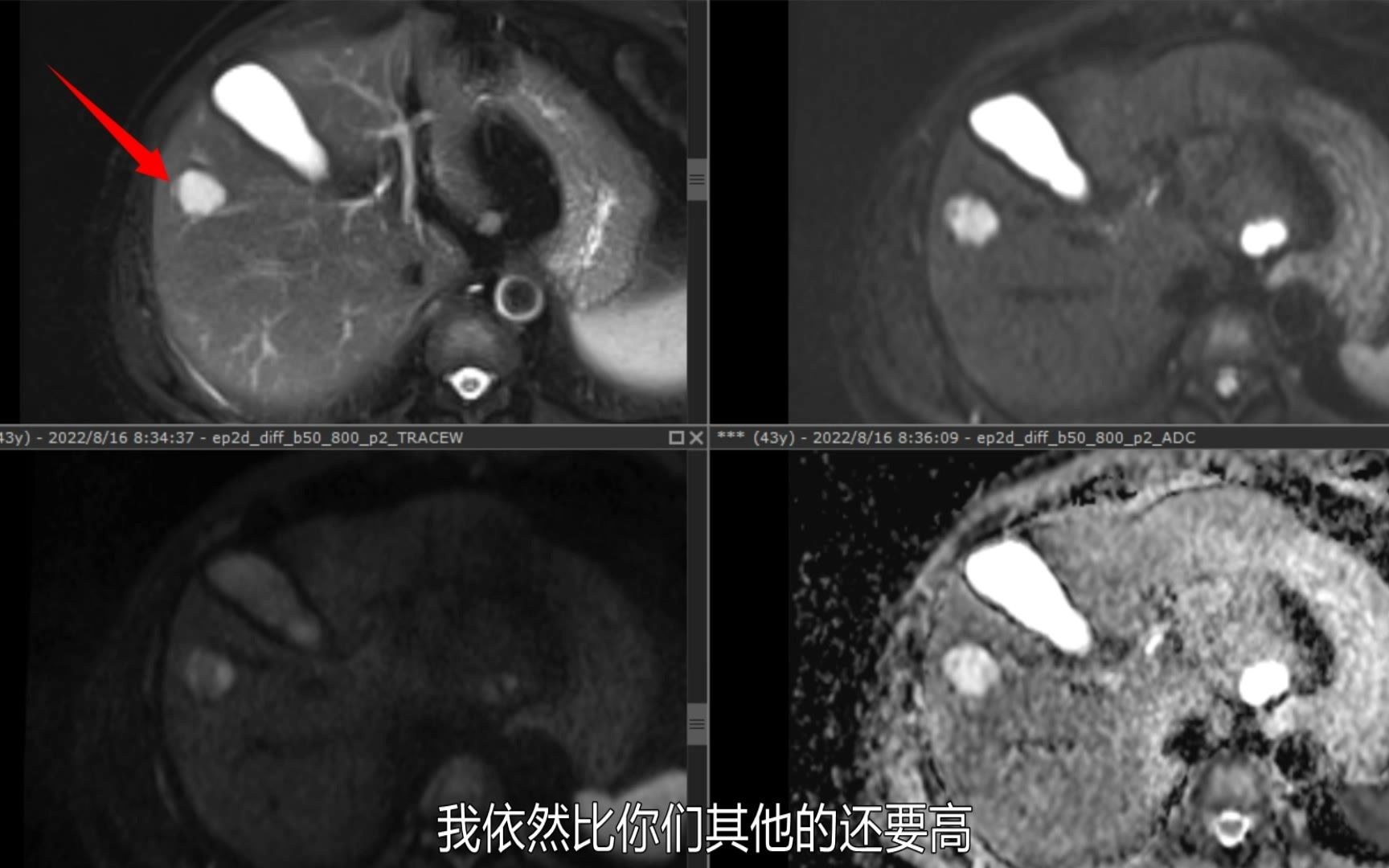 MRI入门教学(3):T2WI透过效应哔哩哔哩bilibili