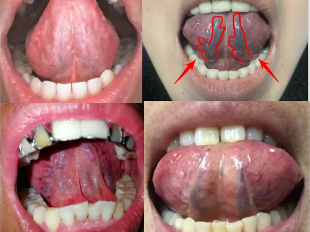 怎么判断自己体内是否有淤血,通过看舌下青筋,来教你判断哔哩哔哩bilibili