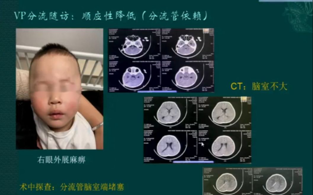 儿童脑室腹腔分流手术并发症:机理与处理【脑积水的新进展学习班】哔哩哔哩bilibili