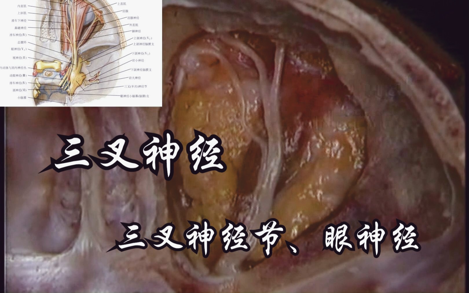 三叉神经:三叉神经节、眼神经哔哩哔哩bilibili