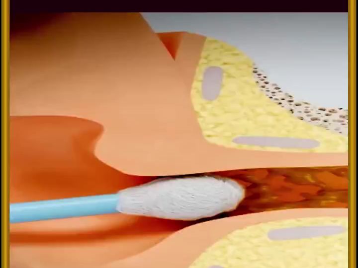 棉签为什么不能掏耳朵