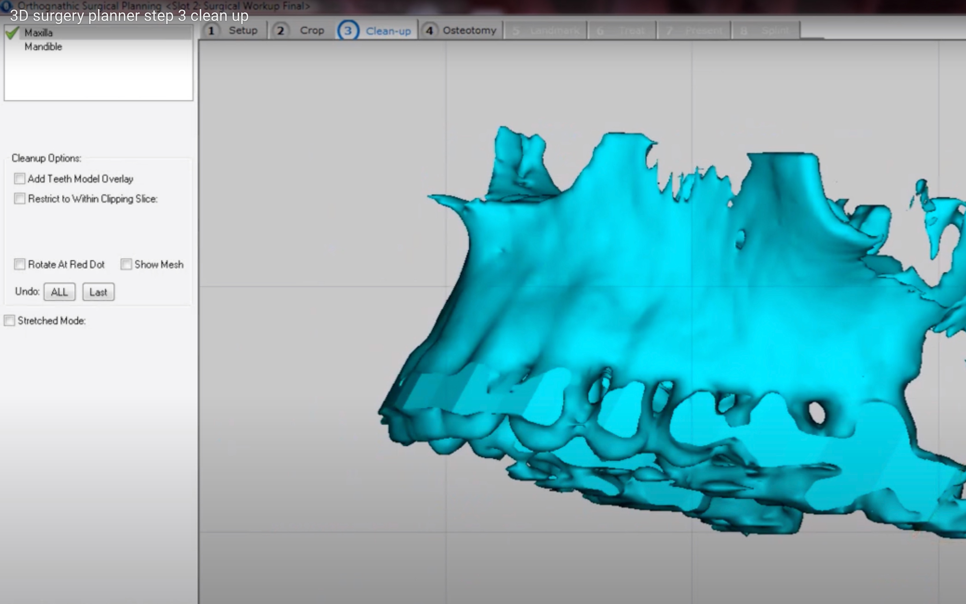 3D surgery planner step 8 splint哔哩哔哩bilibili