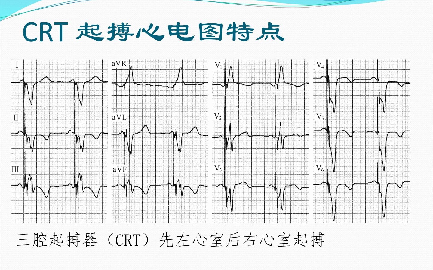 起搏心电图基础哔哩哔哩bilibili