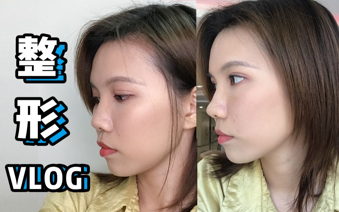 第一次打玻尿酸丨垫了鼻基底,凸嘴改善了,鼻子高了