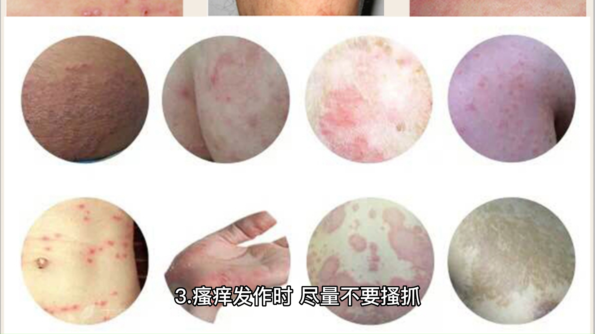 胆碱能性荨麻疹如何护理-上海海华医院科普