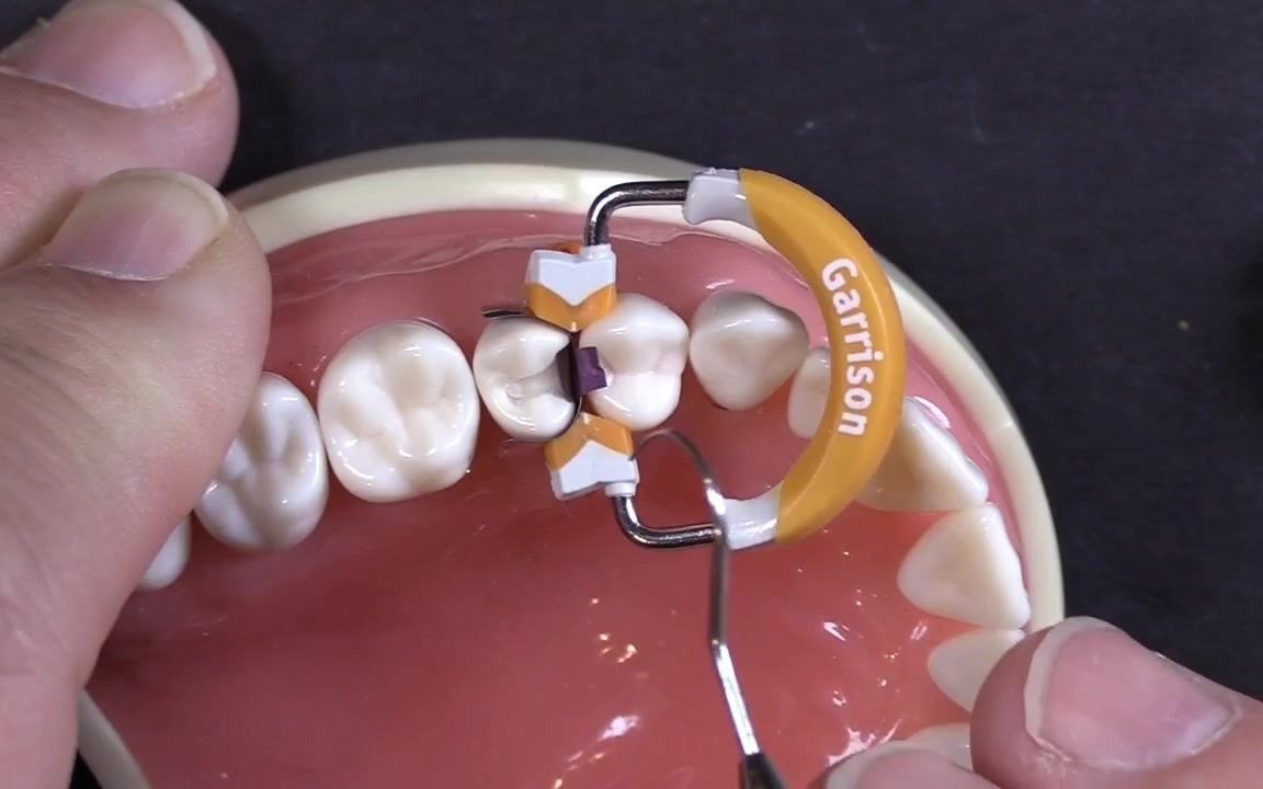 树脂牙周夹板固定图片图片