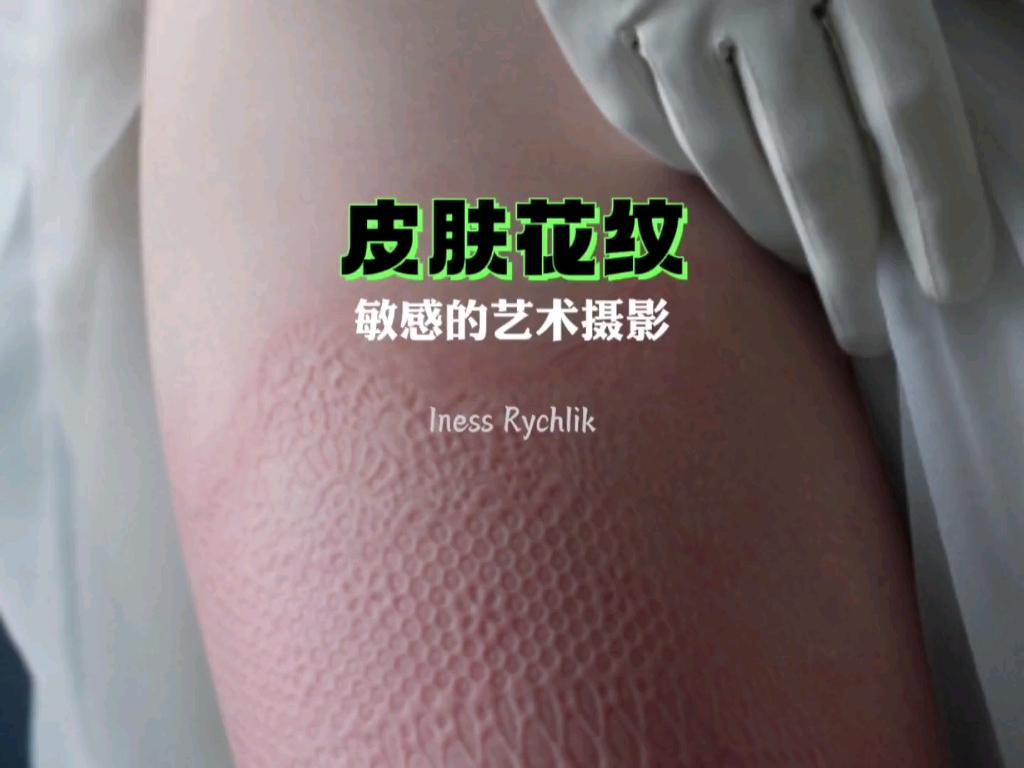 荨麻疹影响下的皮肤花纹艺术哔哩哔哩bilibili