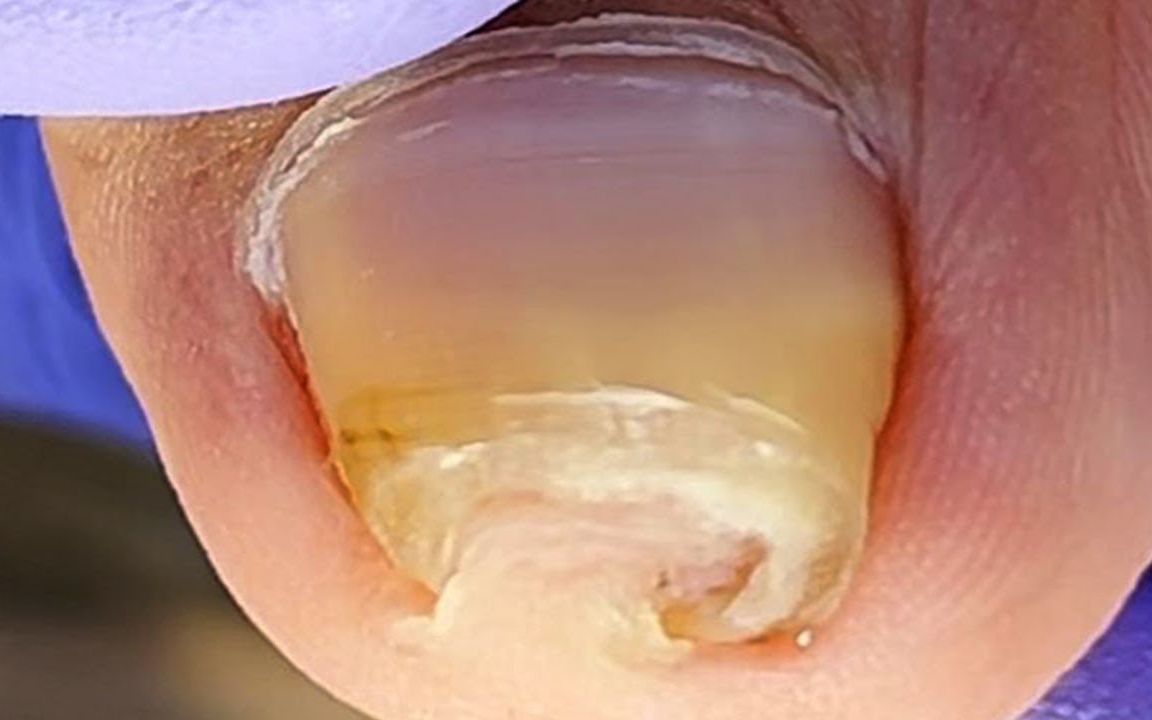 【嵌甲】疯狂卷曲向内生长的脚趾甲,剪起来很疼