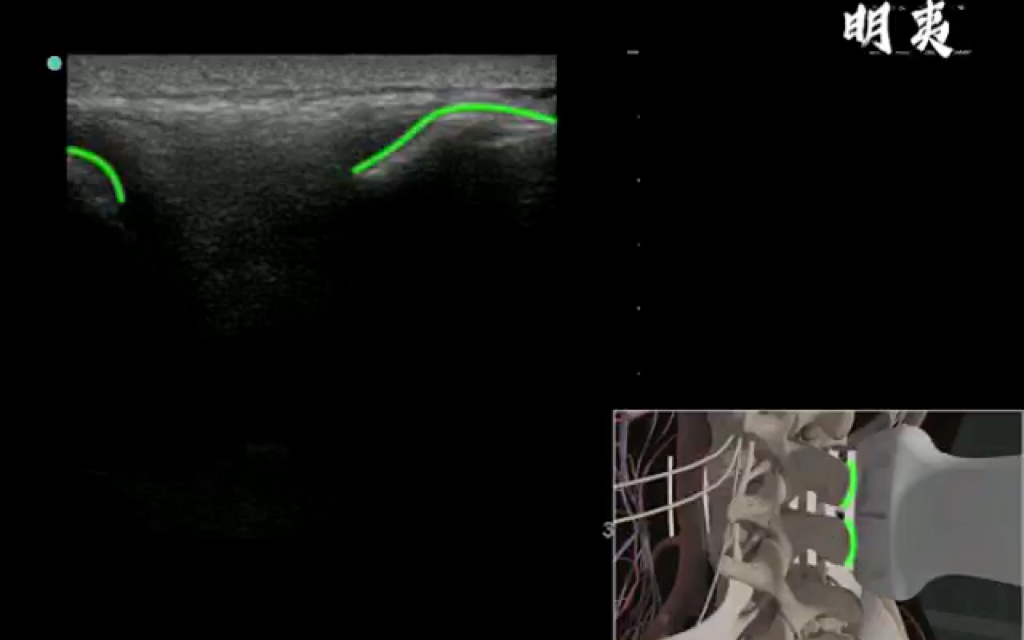 腰椎穿刺 超声引导哔哩哔哩bilibili