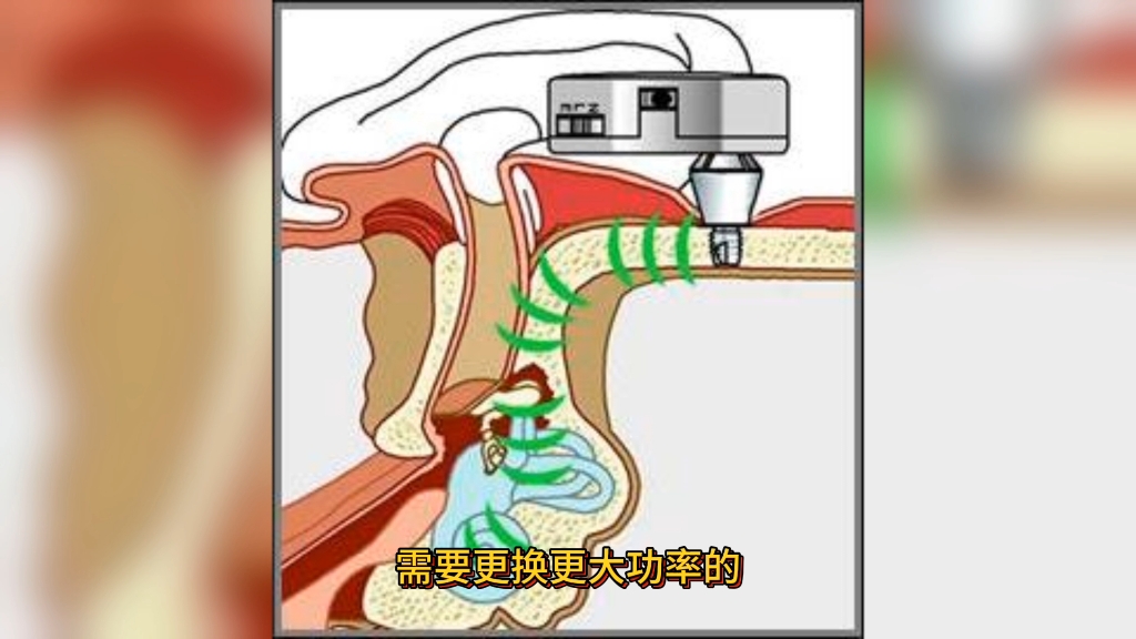 助听器什么时候该更换了呢?哔哩哔哩bilibili