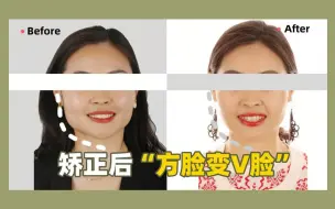 Tải video: 32岁，深覆合 深覆盖，不拔牙矫正，旋转下颌骨，脸型变长变瘦！