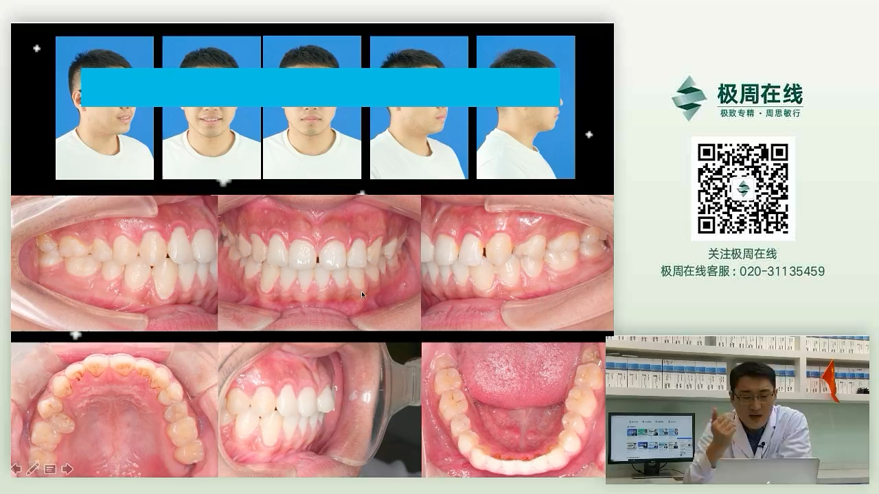 .扬隐形矫治之长、避固定矫治之短一•从固定矫治到隐形矫治的思维转变——孟勇老师哔哩哔哩bilibili
