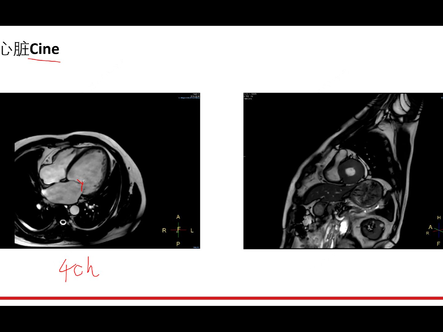 心脏磁共振电影中的时间分辨率哔哩哔哩bilibili