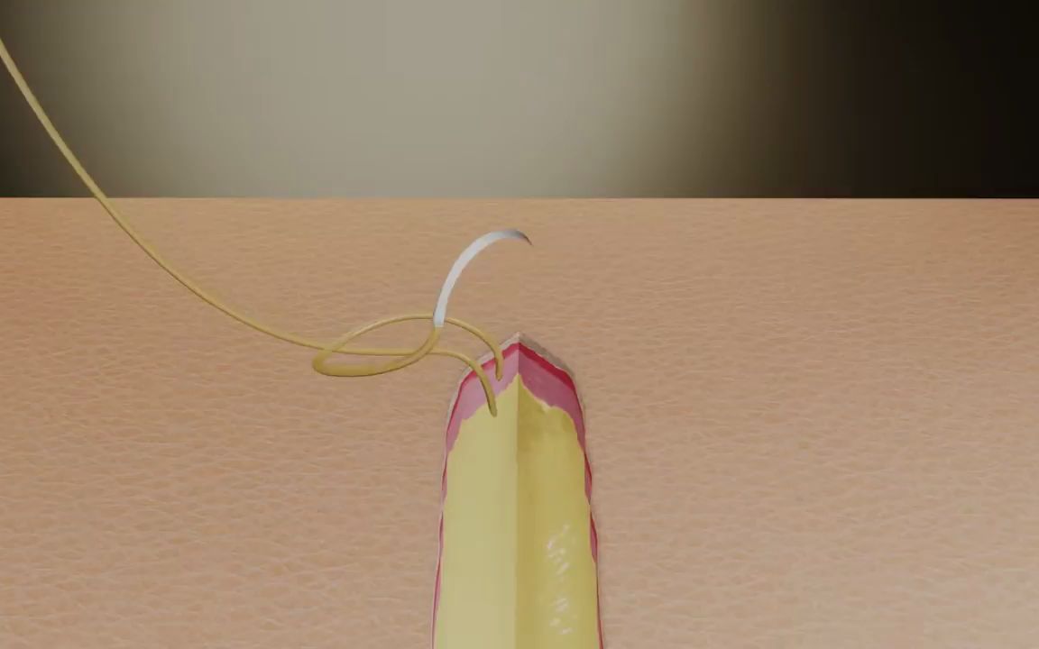 【缝合技巧】【皮内缝合】Suture Techniques:Subcuticular Running Suture  连续皮内缝合哔哩哔哩bilibili