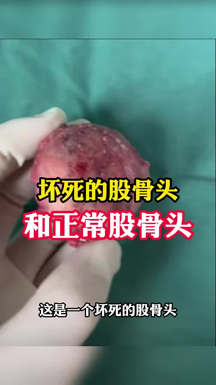 坏死的股骨头和正常的股骨头是啥样子的?哔哩哔哩bilibili