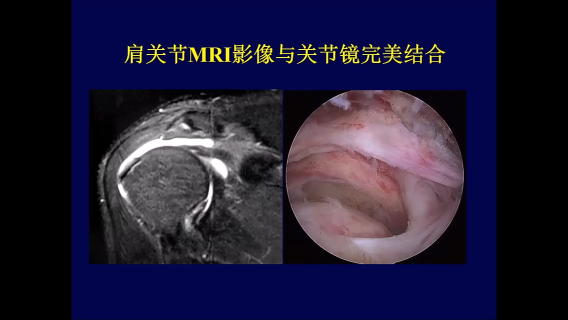 肩关节损失MRI诊断 陈爽 侵删哔哩哔哩bilibili