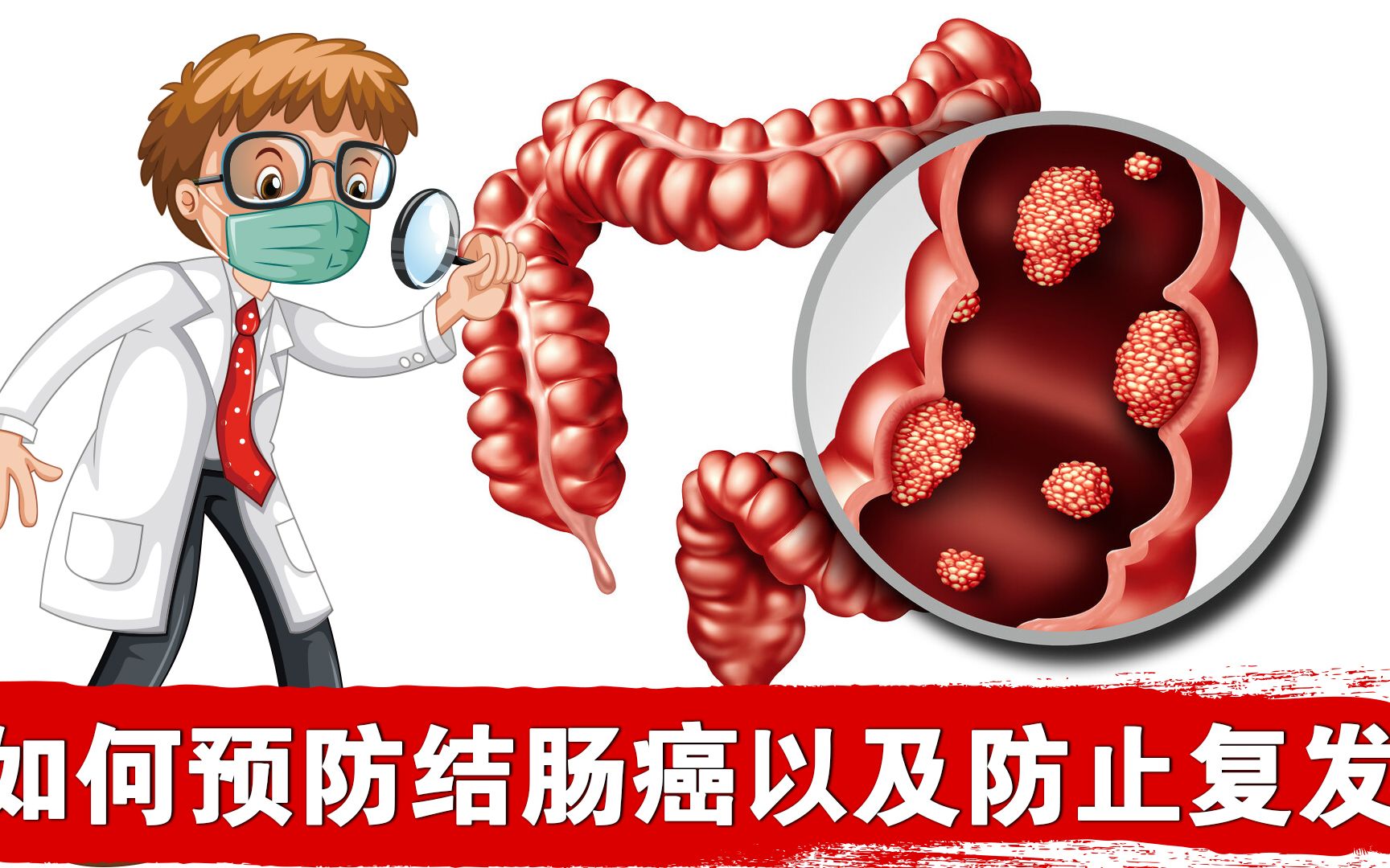 如何预防结直肠癌以及防止术后复发?