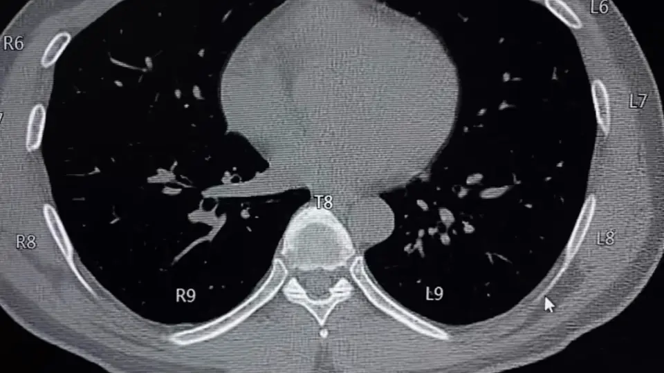 胸部CT 肋骨计数_哔哩哔哩_bilibili