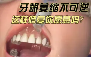 Download Video: 牙龈萎缩虽然不可逆，但也不是没有办法，这种修复方式你愿意试试吗？