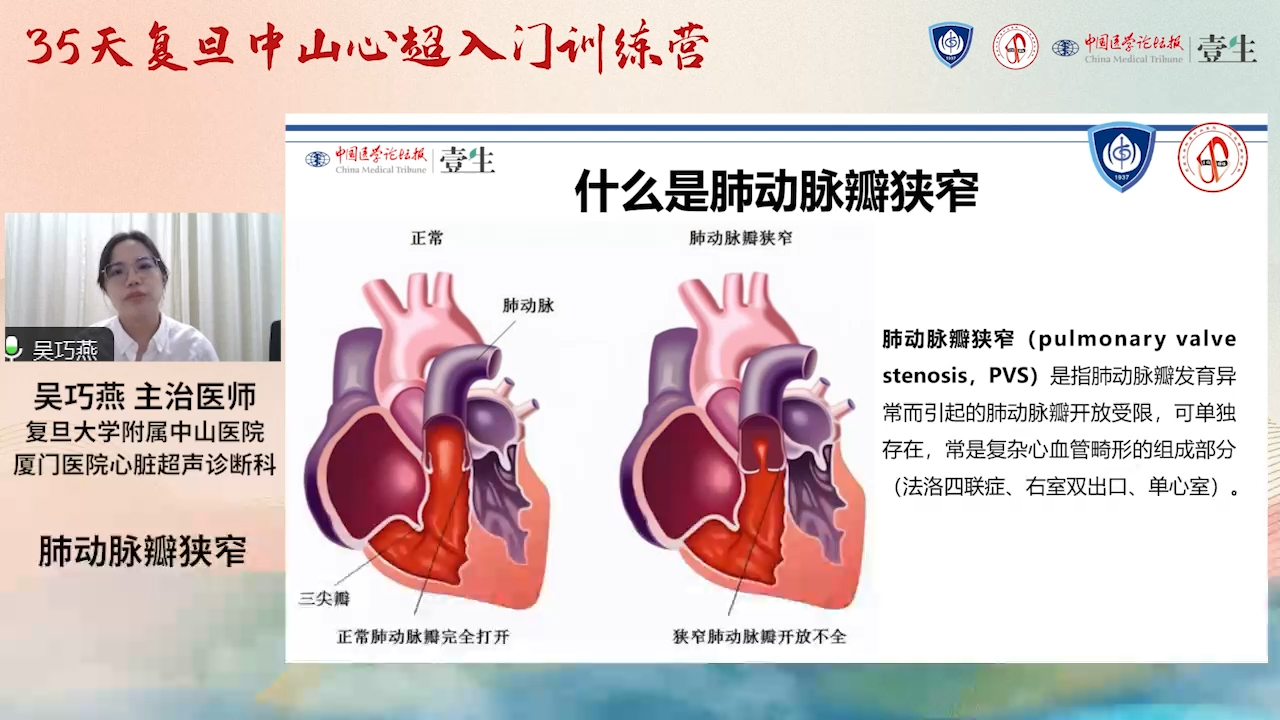 肺动脉瓣狭窄图片图片