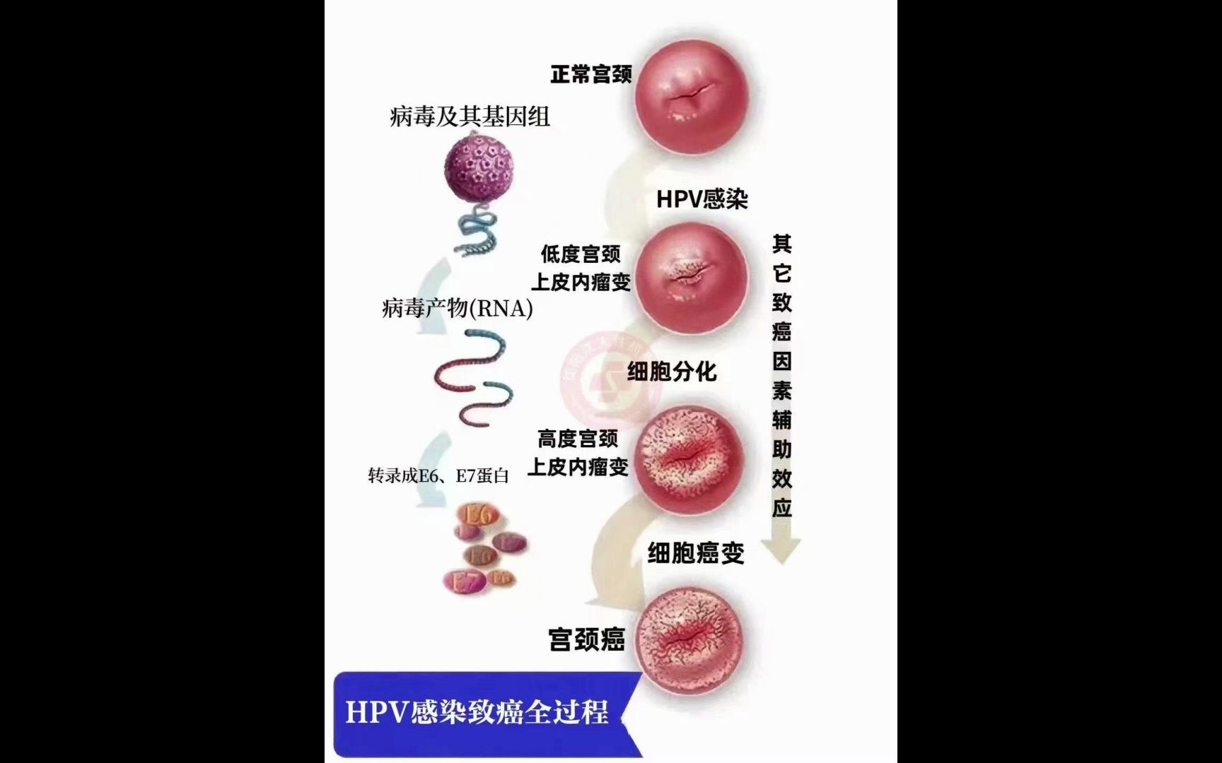 hpv感染致癌全过程 广州科大中医医院