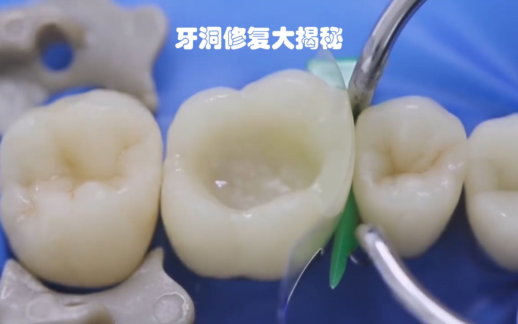 活动作品树脂补牙牙洞被填满看着就是不一样