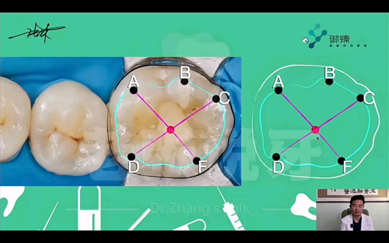 上下6牙合面形态