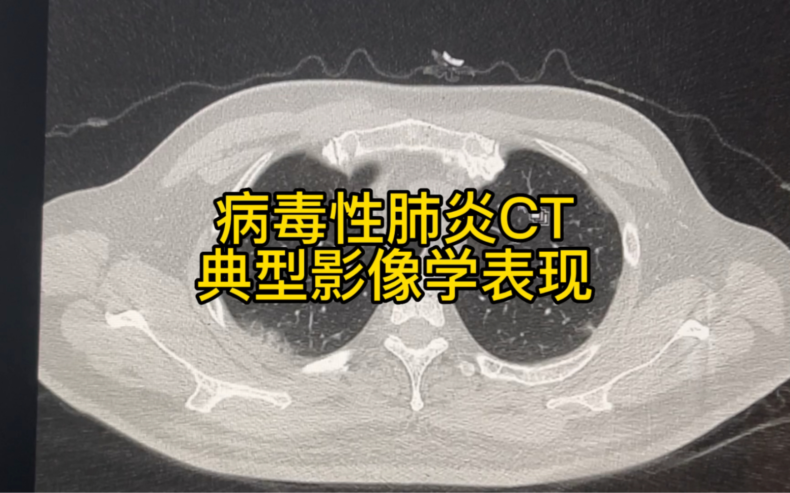 [图]4天时间病毒性肺炎影像学有所吸收，看看典型病毒性肺炎CT上有哪些表现