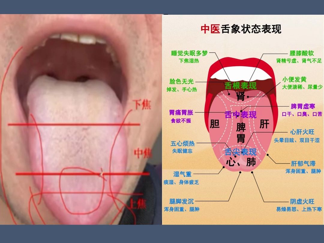 舌诊分析 肝胆受伤