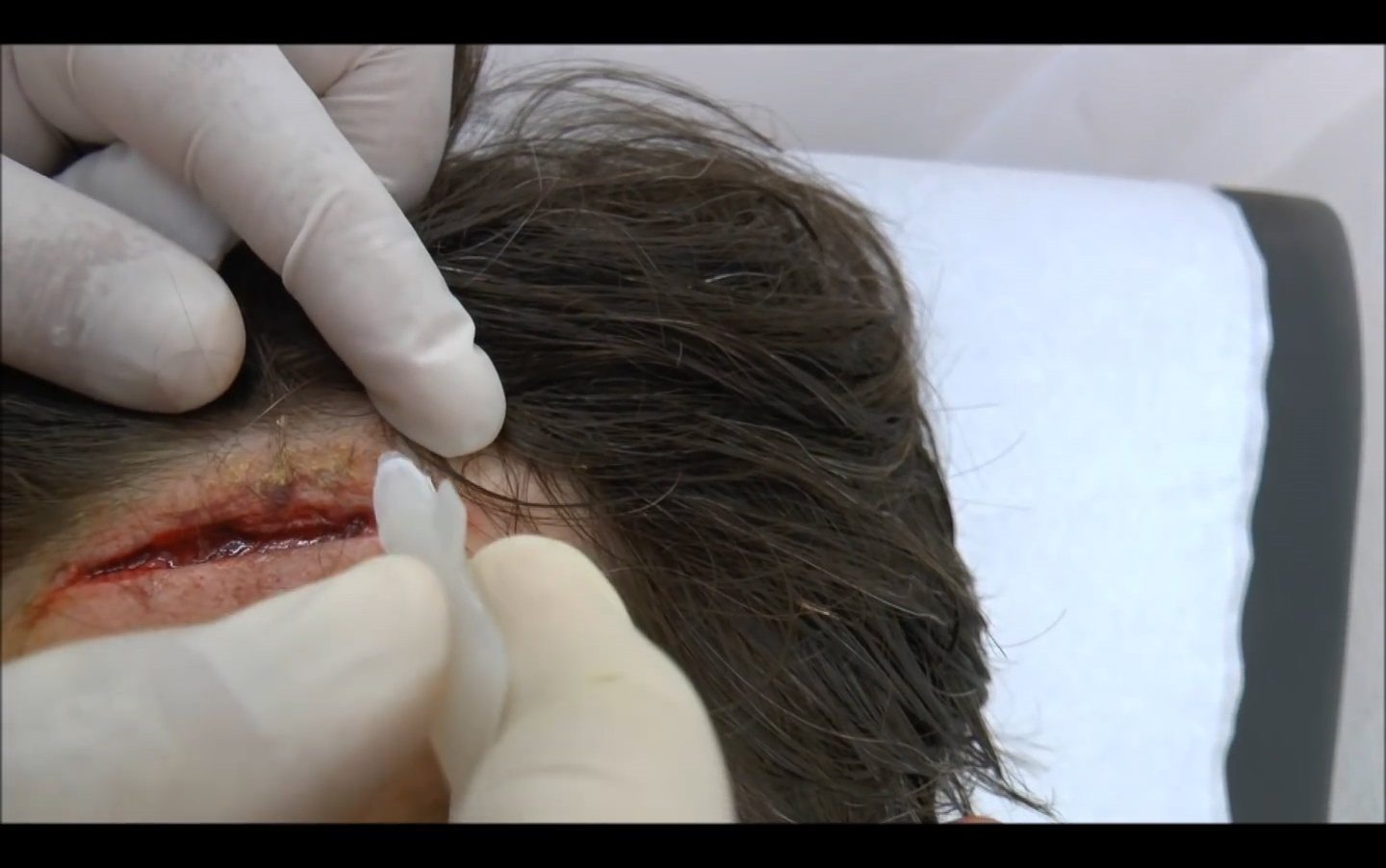 老外发明医疗胶水,滴在伤口只需60秒就能愈合,还不会留下疤痕