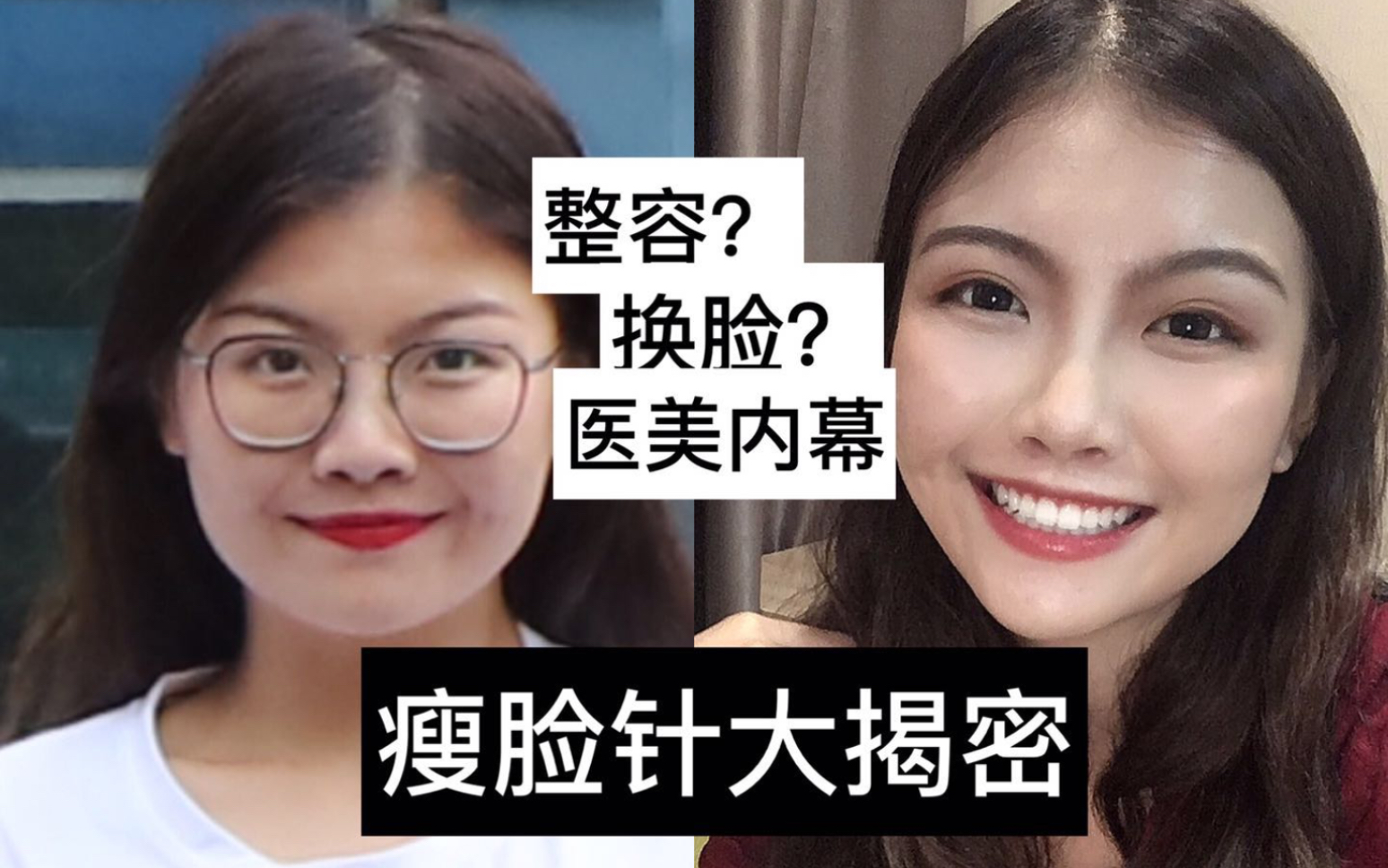 第一次打瘦臉針vlog|圓臉變v被女友誇效果超明顯|醫美經驗分享