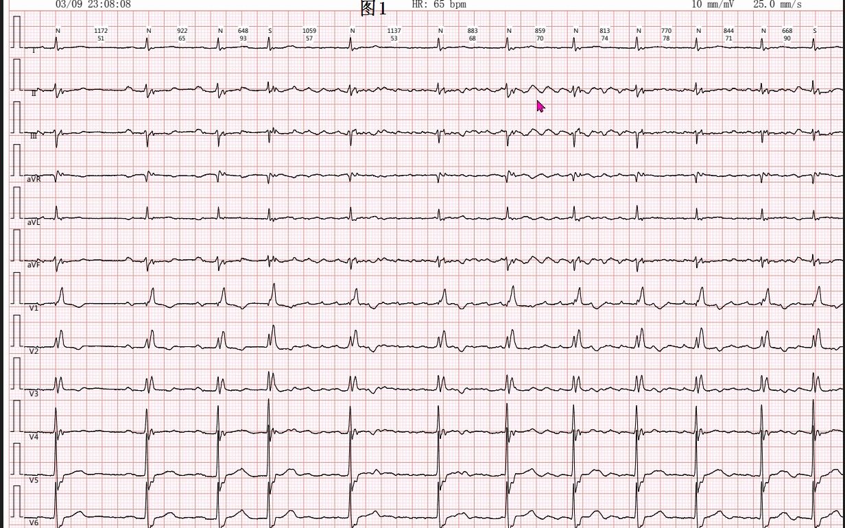 [图]阵发性心房扑动、心房颤动、房性心动过速