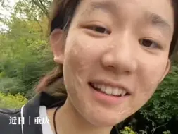 Скачать видео: 女孩受伤后脸上留下疤痕，直言请不要想象我以前有多美！