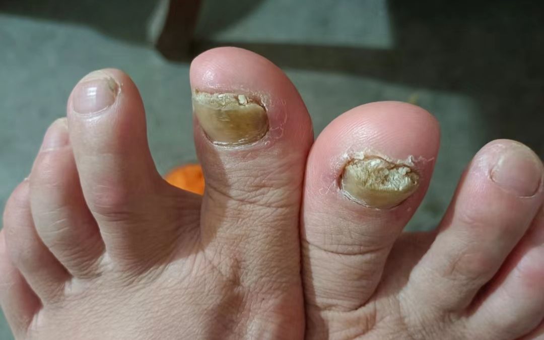 告别无效治疗!去灰指甲最有效3个方法,直接帮你省下好几千块!