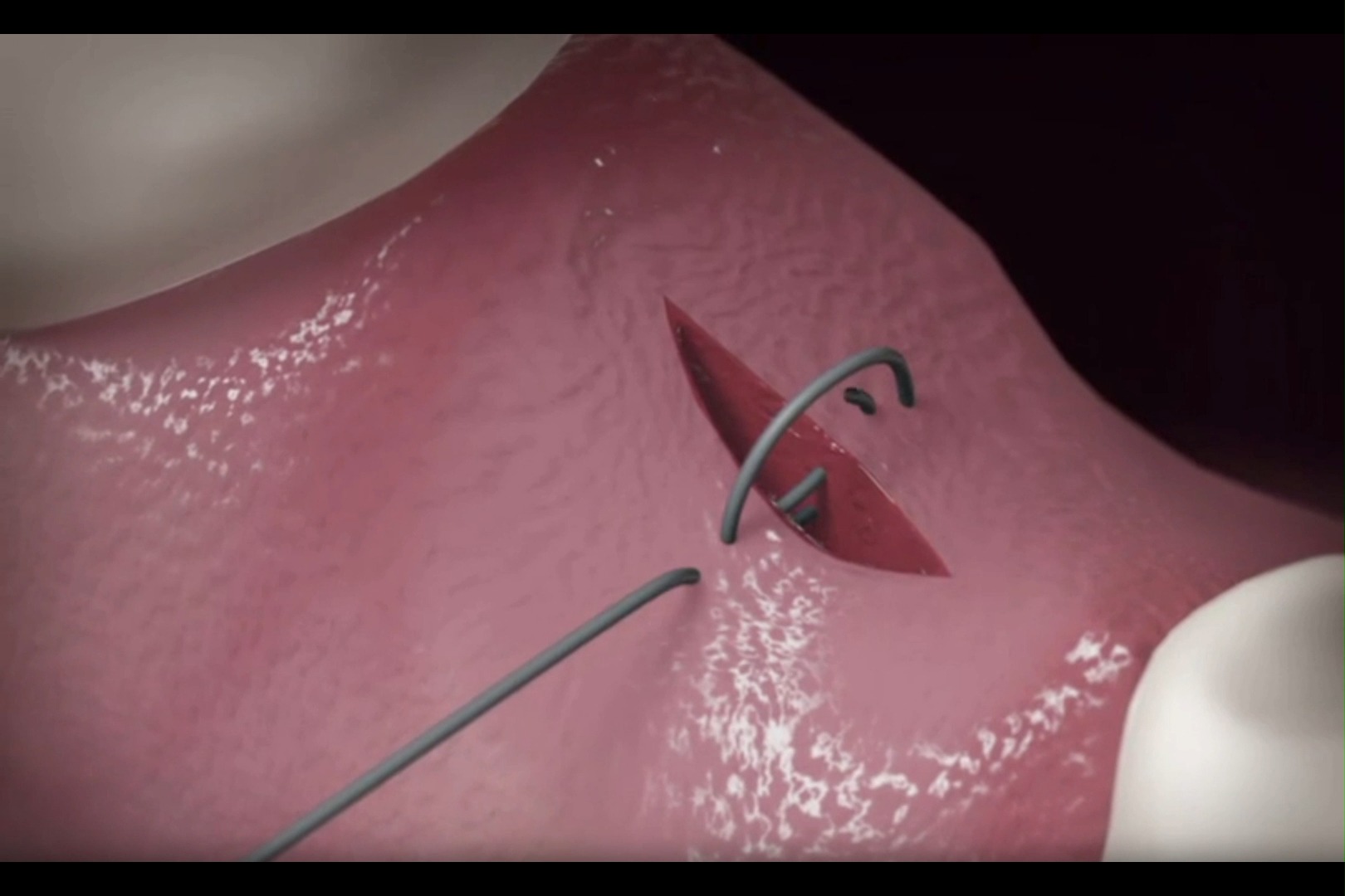 口腔种植外科缝合之双圈线缝合