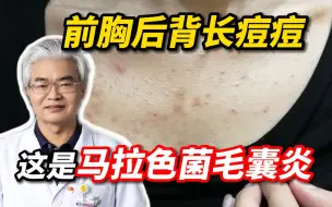 Download Video: 【毛囊炎】前胸后背长痘痘，皮肤科医生唱歌教你解决！