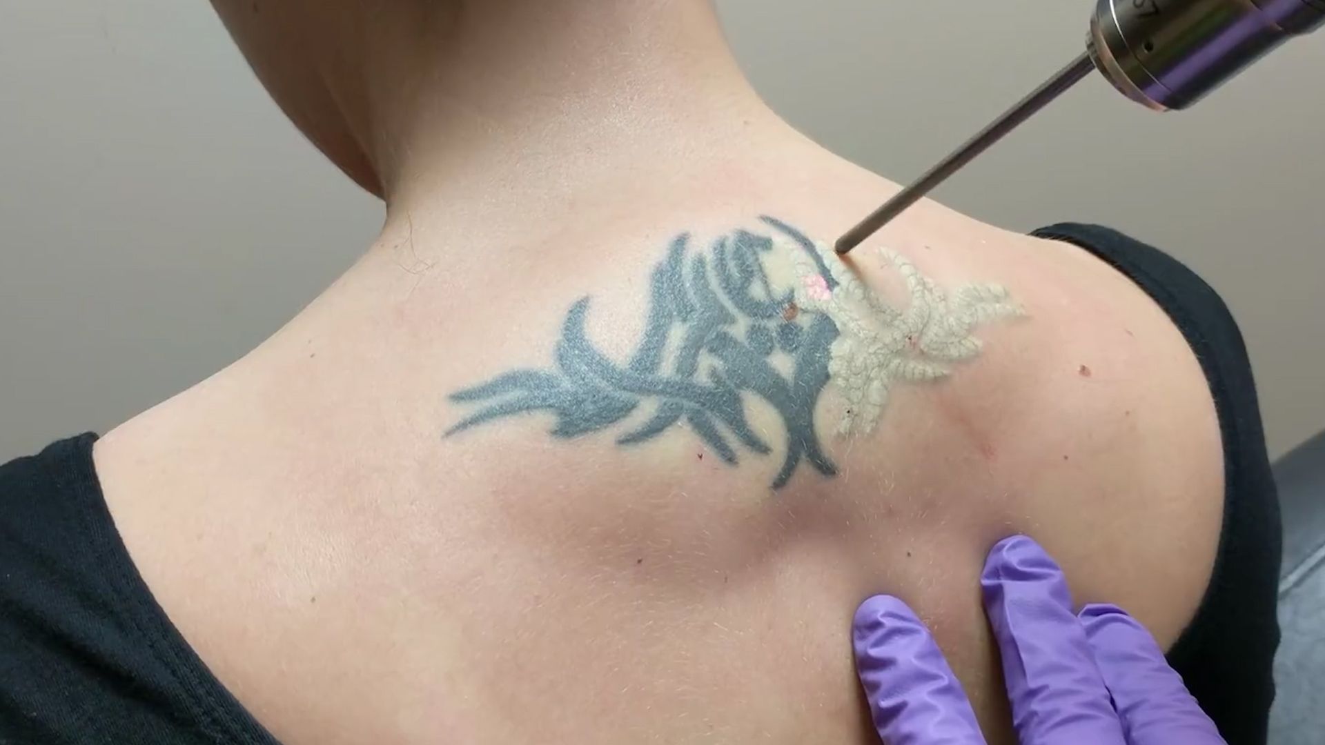 用激光去除纹身图案,原来过程如此麻烦,竟然过程还不打麻药