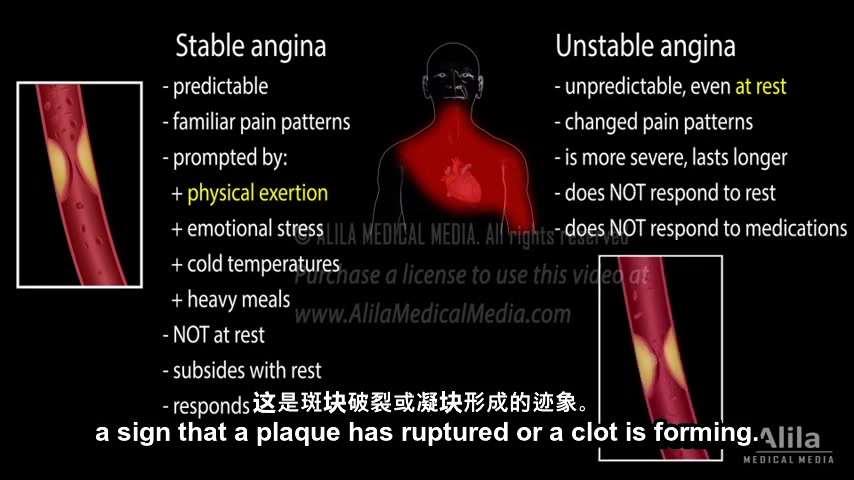 心绞痛常见这4种症状,心绞痛的治疗方法有哪些?哔哩哔哩bilibili