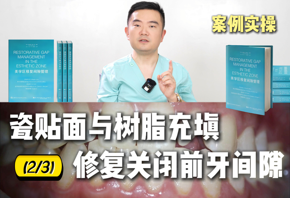 过小牙导致的前牙间隙,瓷贴面与树脂充填搭配操作,注意事项有哪些呢?(2/3)哔哩哔哩bilibili