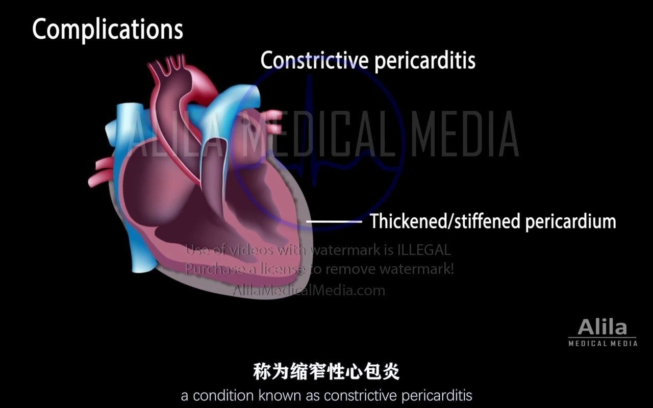 [图]【Alila Medical Media】27.心包炎的症状、病理生理学、病因、诊断和治疗