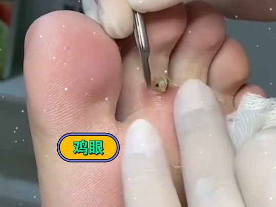 脚底板的鸡眼连根拔起