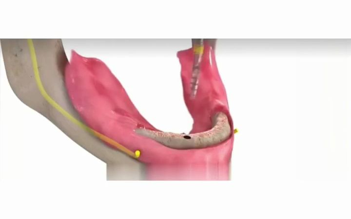 仙游半口种植牙|一条视频带你了解半口种牙全过程哔哩哔哩bilibili